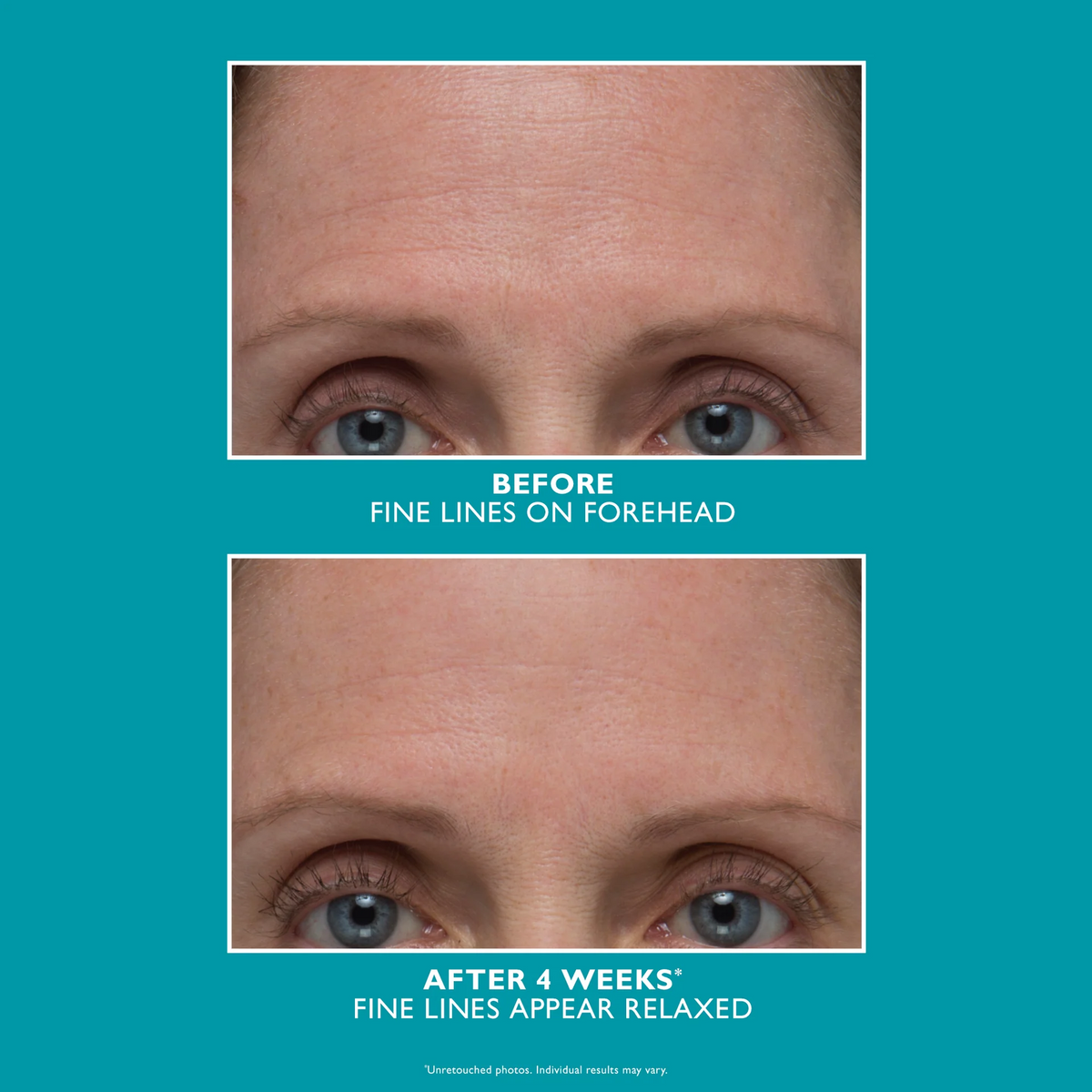 Peptide Skinjection Amplified Wrinkle-Fix Serum - Інтенсивна сироватка для боротьби зі зморшками Peter Thomas Roth