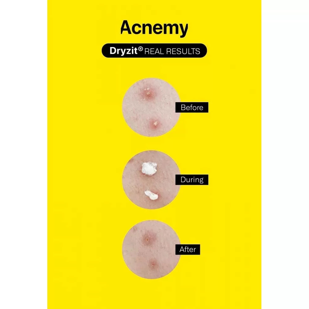 Acnemy Dryzit — підсушуючий точковий лосьйон від прищів